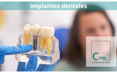 Todo lo que necesitas saber sobre implantes dentales en Vigo