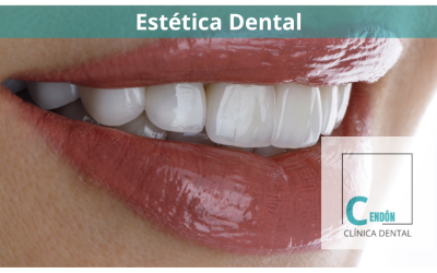 Estética dental: Consejos para una sonrisa radiante y natural