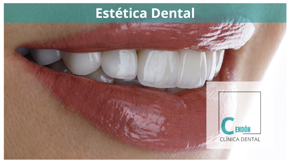 Estética dental: Consejos para una sonrisa radiante y natural