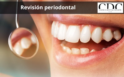 ¿Cómo saber si necesitas una revisión periodontal en Vigo?