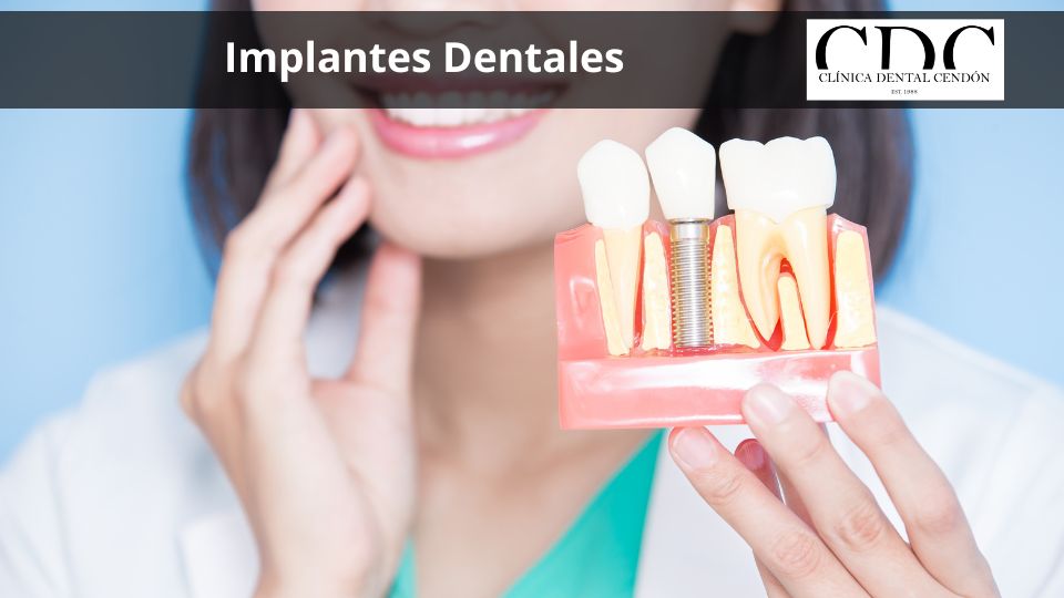 Implantes dentales en Vigo: todo lo que necesitas saber antes de tu tratamiento